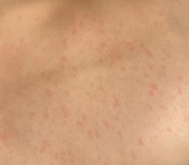 一岁宝宝突然发高烧反反复复,一岁半的孩子持续高烧五天了