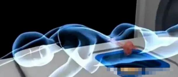 海扶刀很好吗,海扶刀为啥叫海扶刀