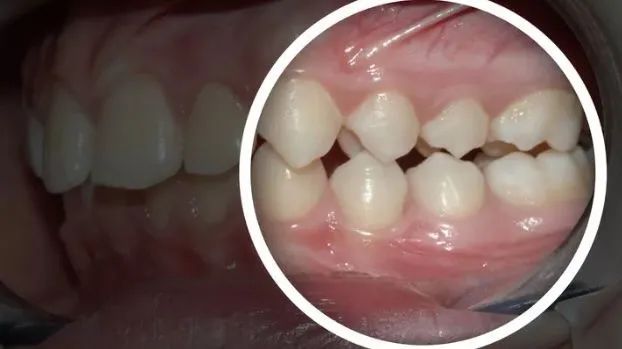 这两天总是咬腮帮子是上火吗,吃饭总咬嘴是预示什么