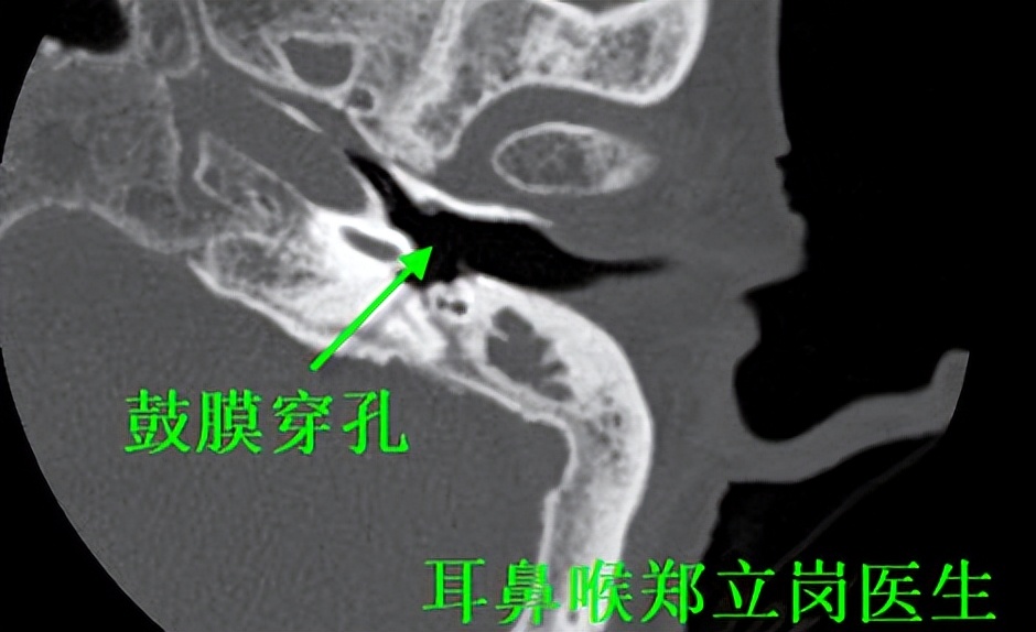 老人家有中耳炎，治疗还有不要嘛