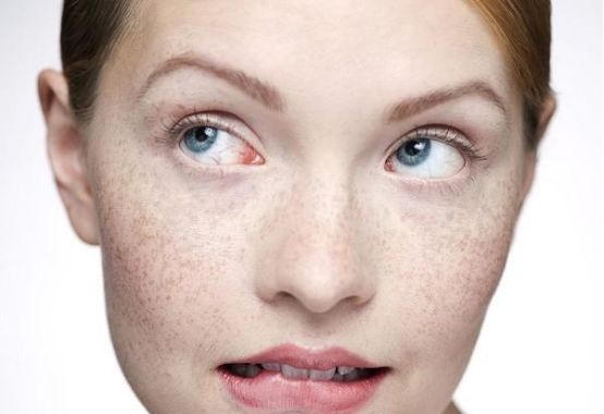 夏季晒太阳皮肤起红疹怎么办,夏季太阳晒脸上长痘怎么办