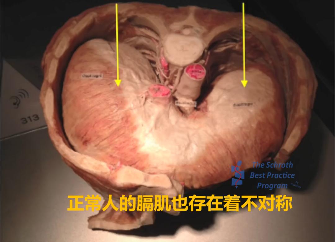 胸椎稍向右侧侧凸怎么矫正,儿童胸椎向右侧凸是什么意思