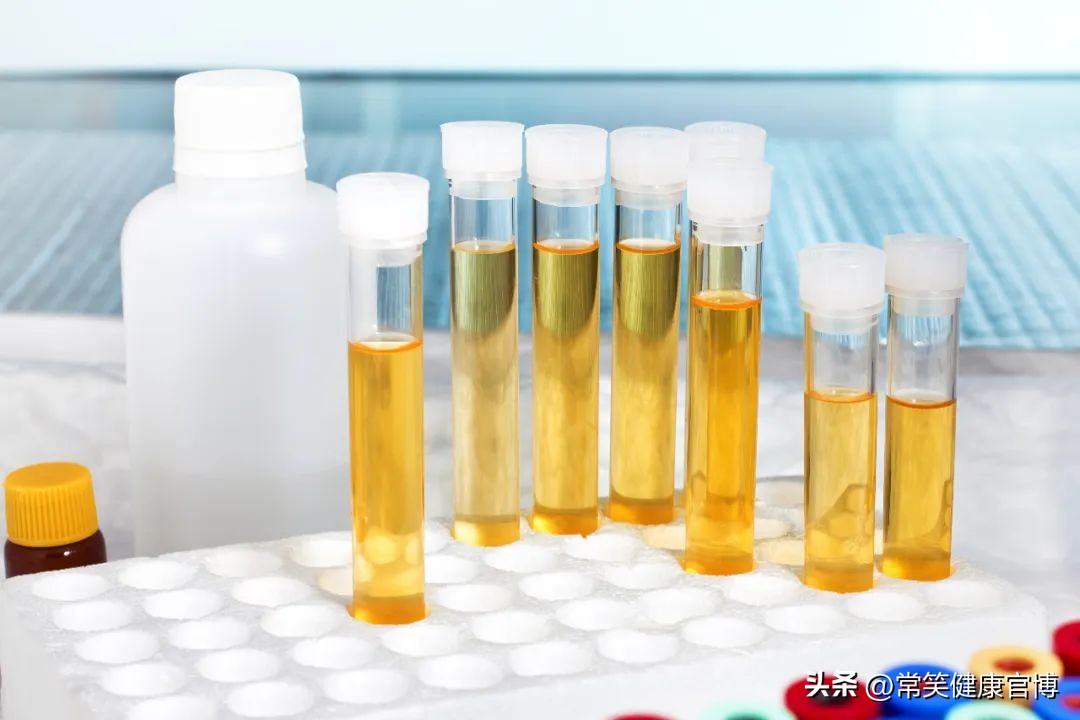 尿液中泡沫多，是不是蛋白尿？真相其实还有这些