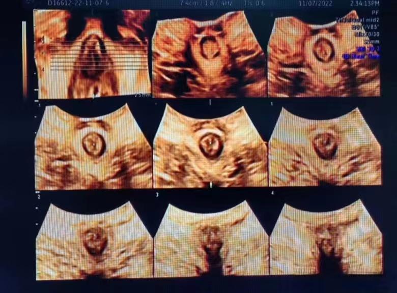 关爱女性盆底健康图片,呵护女性从盆底康复开始