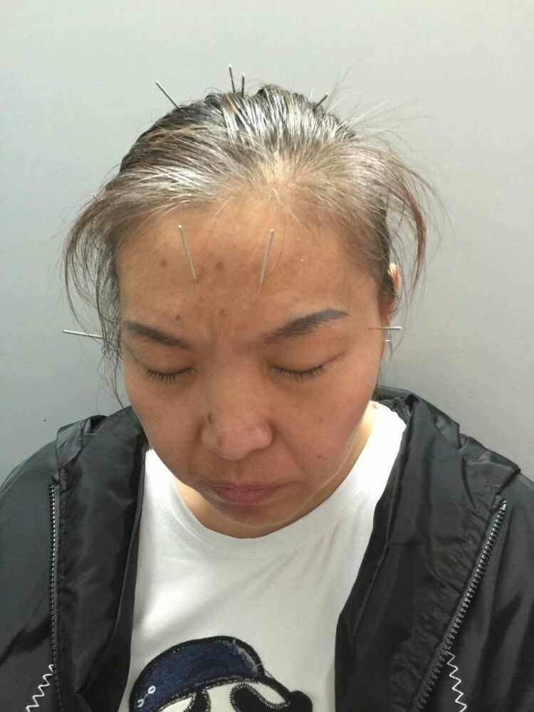 中医扎针治疗偏头痛,夹脊脉冲电针疗法