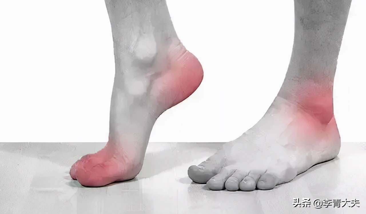 防治痛风小常识,一文搞清楚有关痛风的那些事儿