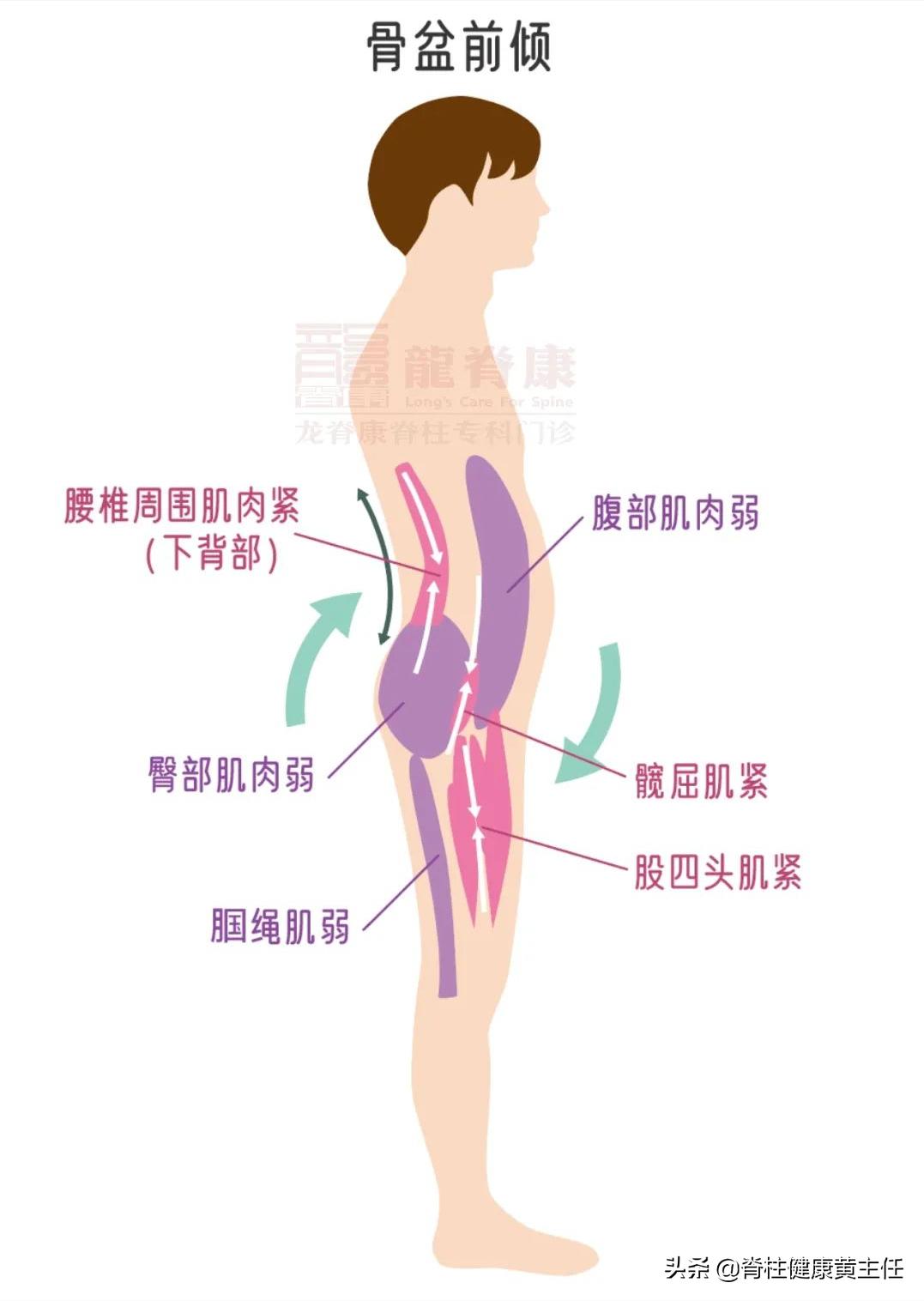 小腹突出骨盆前倾怎么纠正,怀疑骨盆前倾需要去医院治疗吗