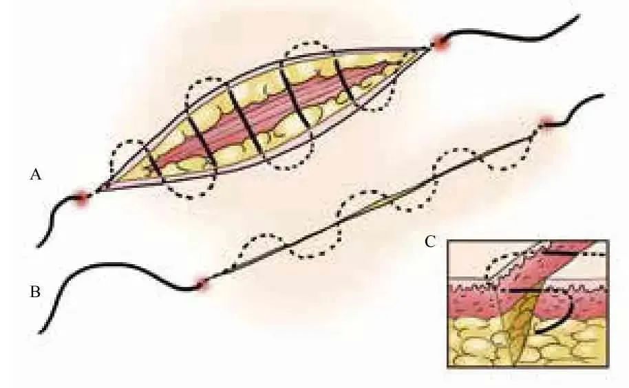 3分钟get:真正的外科缝合秘籍