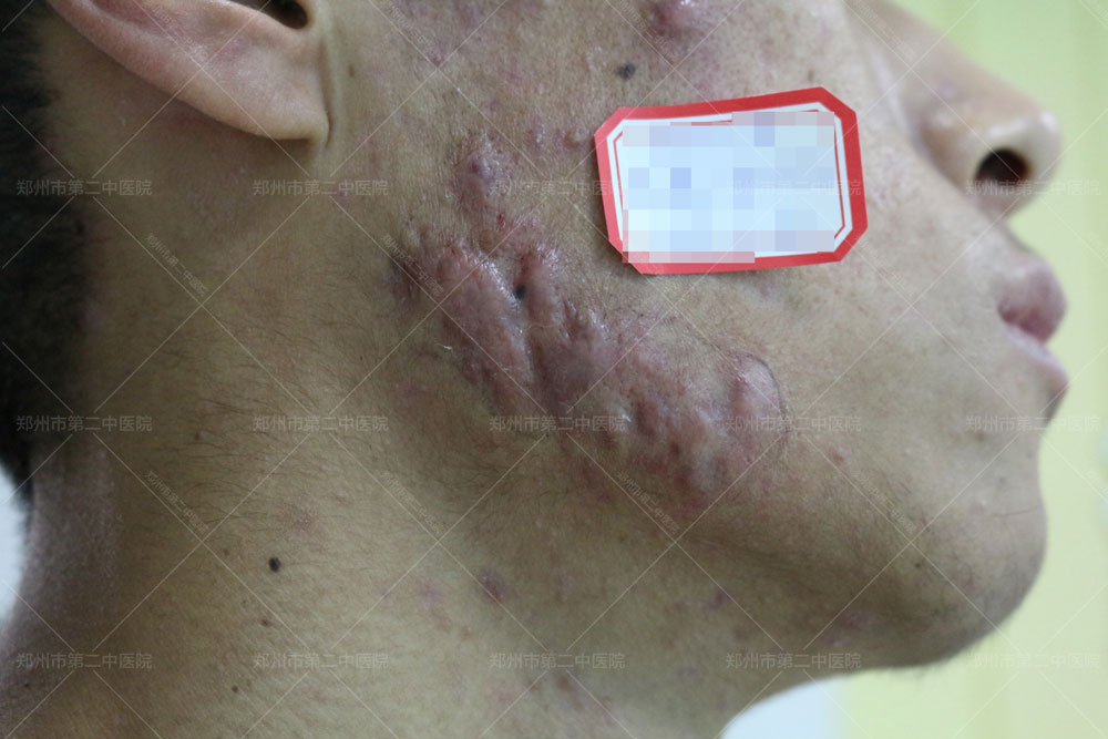 中医怎样治疗增生性疤痕疙瘩,郑州市第二中医院疤痕科祛痘坑