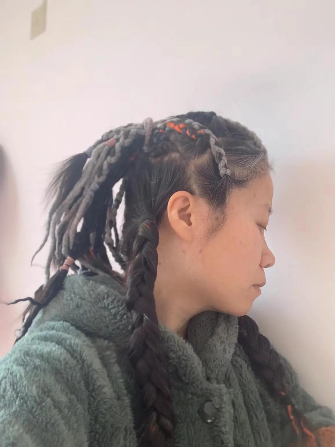 抗癌日记终结篇,宫颈癌转移抗癌成功案例