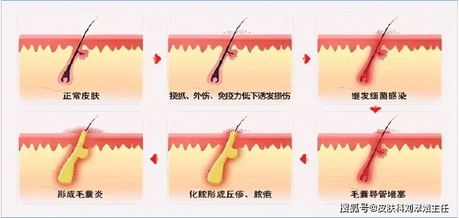 头皮长疙瘩怎么回事怎么解决,头皮上长疙瘩怎么治疗彻底
