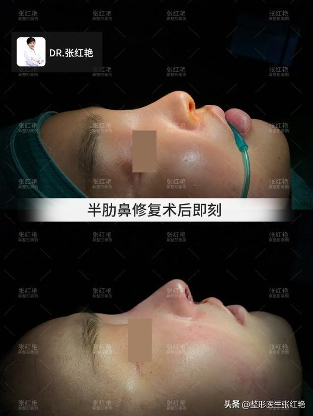 鼻额角怎么做比较有弧度,转折明显的鼻额角好看吗