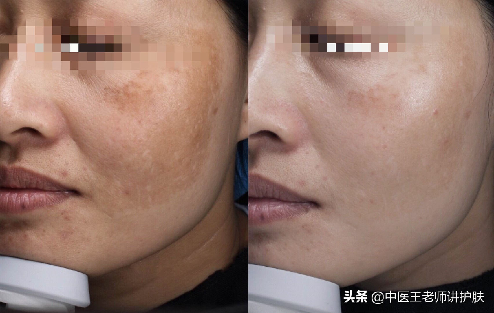 脾虚血瘀长斑怎么食疗,脾虚长痘吃中药多久能见效