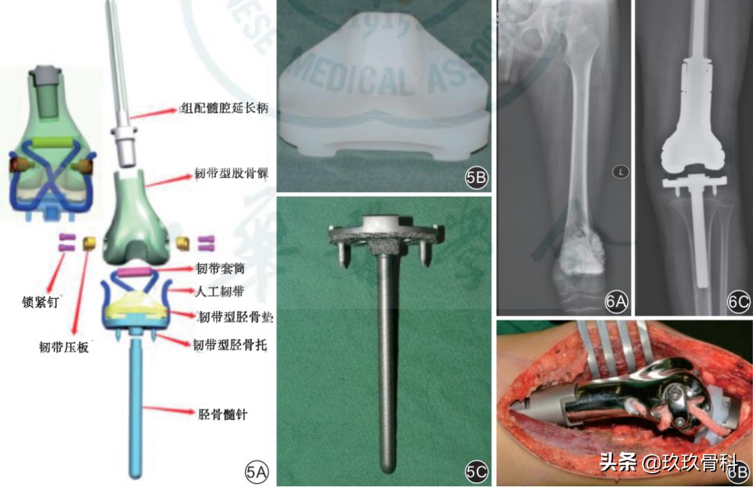 人工关节假体的诞生和发展,国产肿瘤型人工关节假体