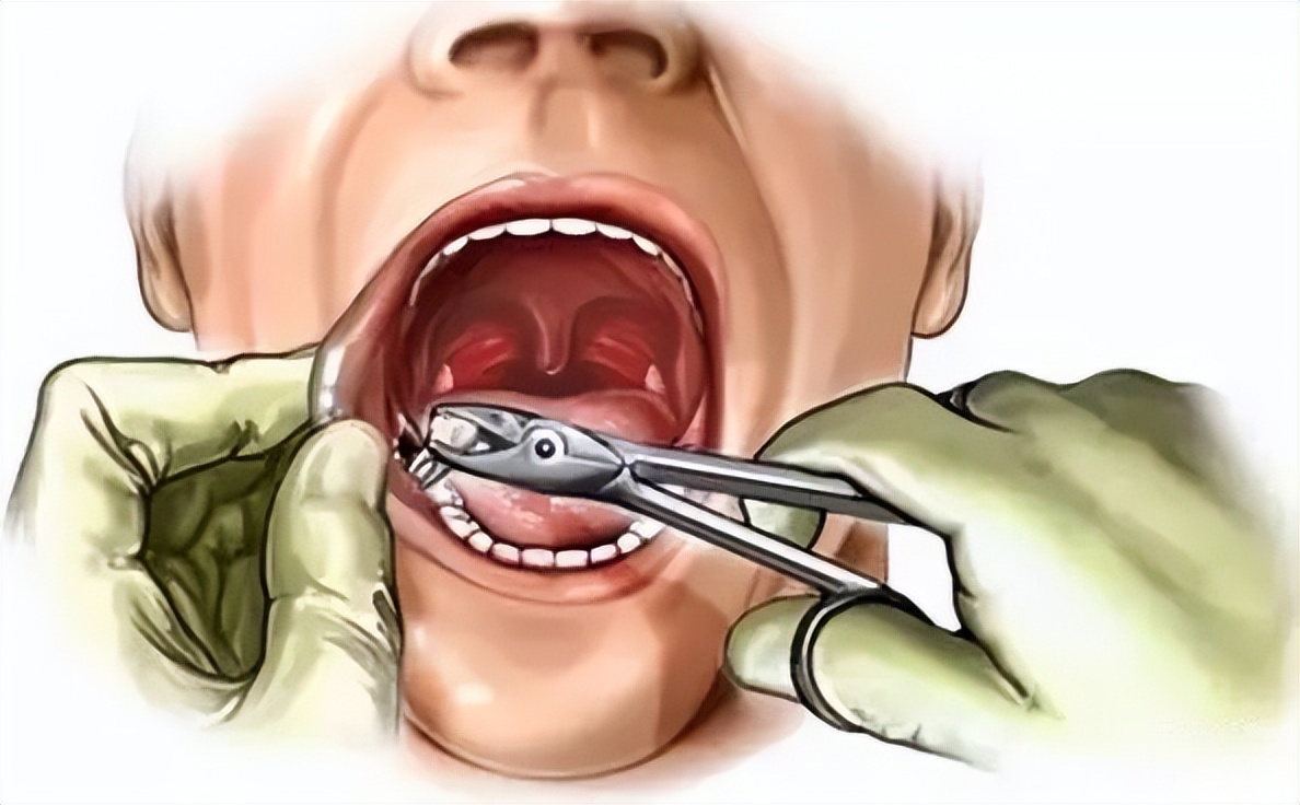 拔牙后持续疼痛需要吃消炎药吗,拔牙疼痛属于几级疼痛