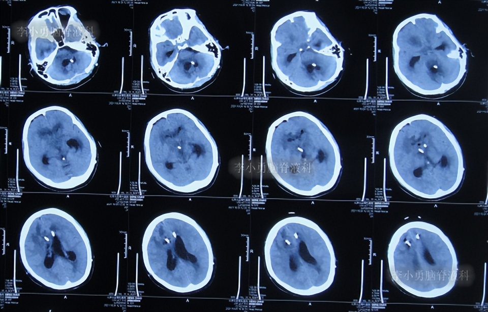 脑积水三脑室造瘘多久能恢复,脑囊虫手术后脑积水