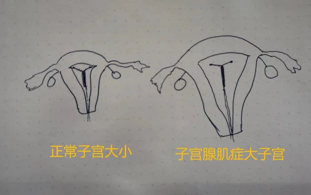 子宫腺肌症让子宫变大，“曼月乐”环也挂不住，咋办？