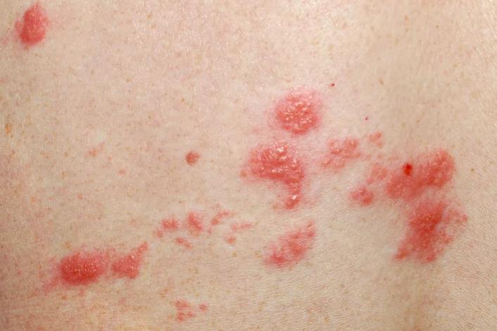 老年人得疱疹两个月了手上还是疼,老年人得了疱疹隔三差五好不了