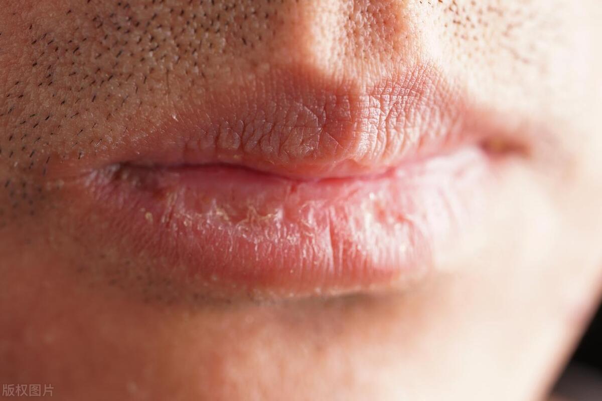 秋冬嘴巴干燥起皮吃什么,秋冬嘴巴周围干燥怎么解决