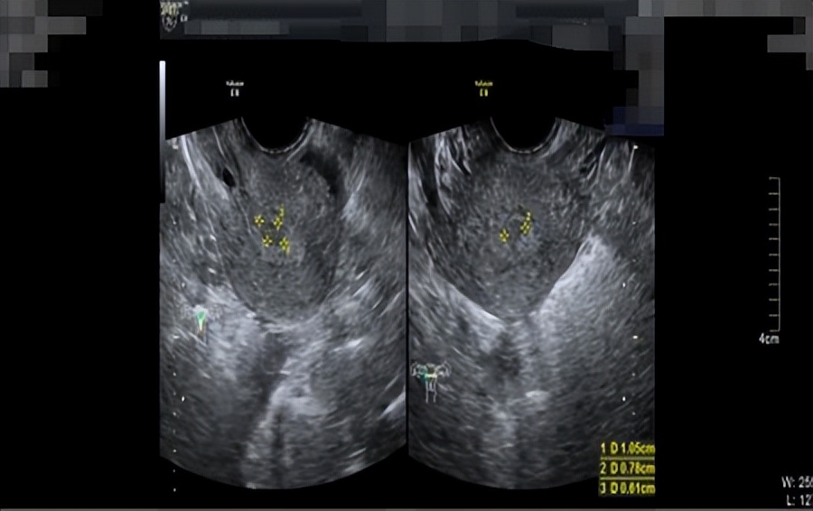 子宫内膜癌的阴道出血症状,子宫内膜癌阴道出血症状