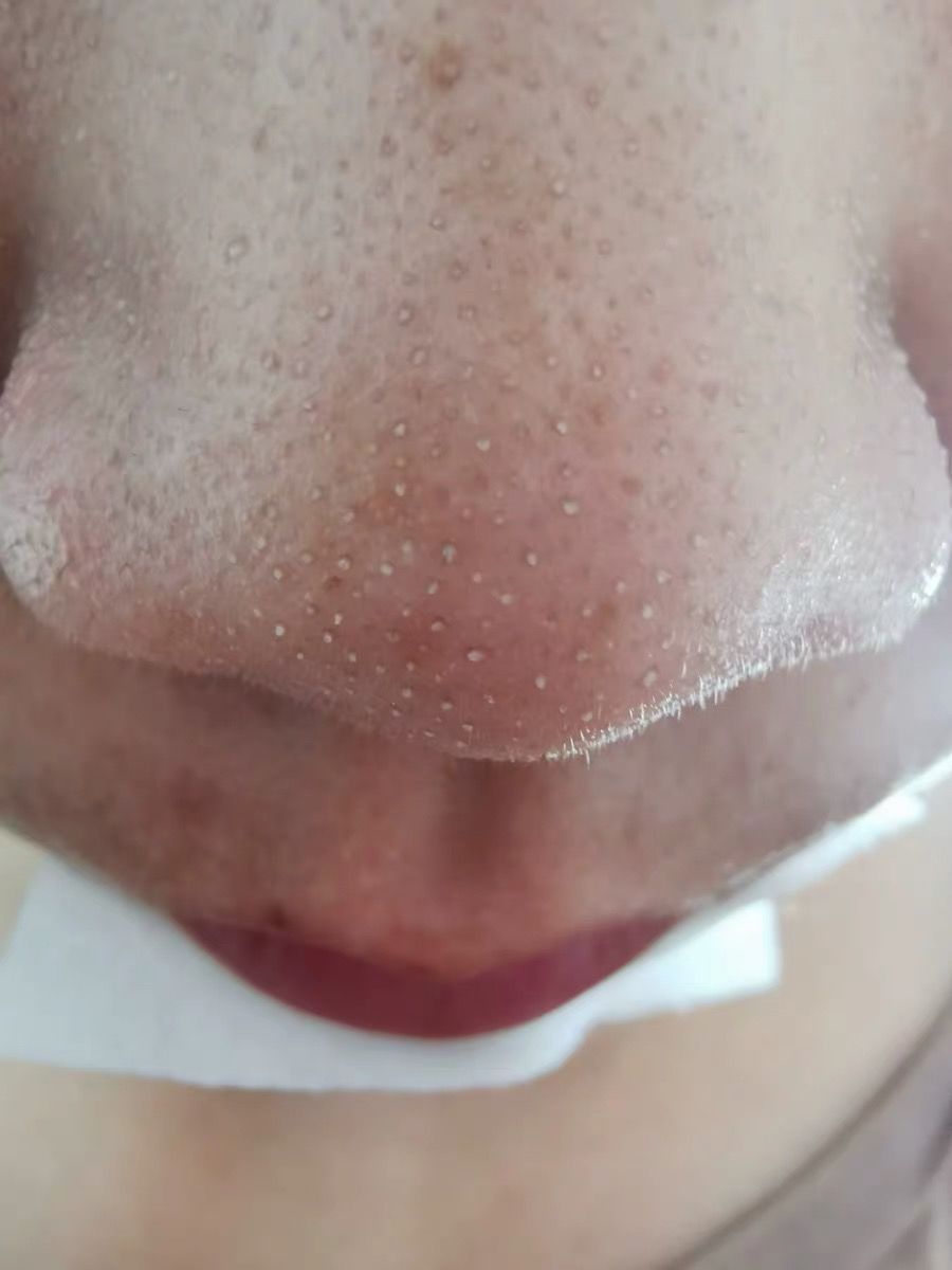 鼻子黑头挤出水一样的液体,鼻子挤黑头粉刺