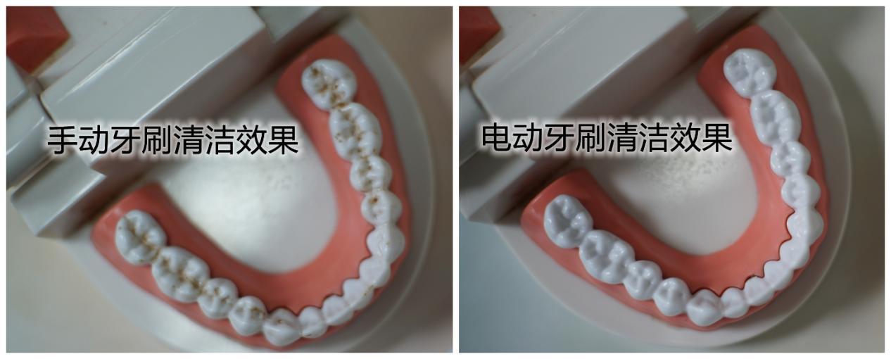电动牙刷牙酸是怎么回事,用电动牙刷牙齿酸怎么回事