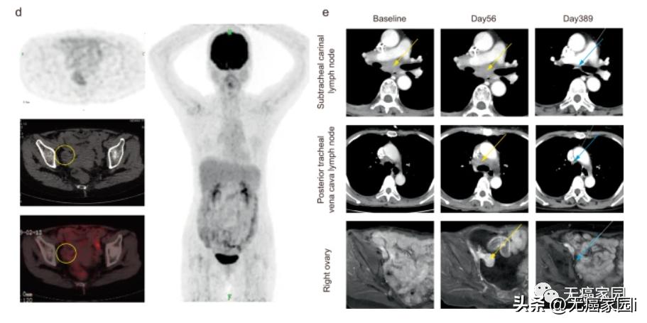 最新癌症疫苗已进入临床试验阶段,预防癌细胞的疫苗是什么