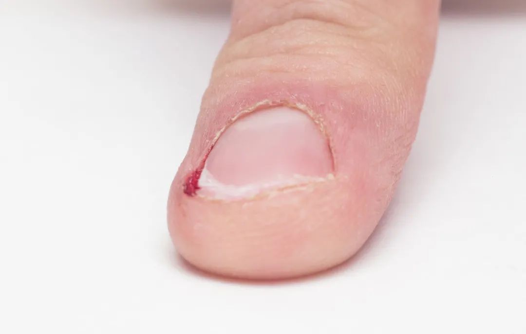 指甲盖出现横纹是什么病,指甲盖上起竖纹白斑是死亡信号