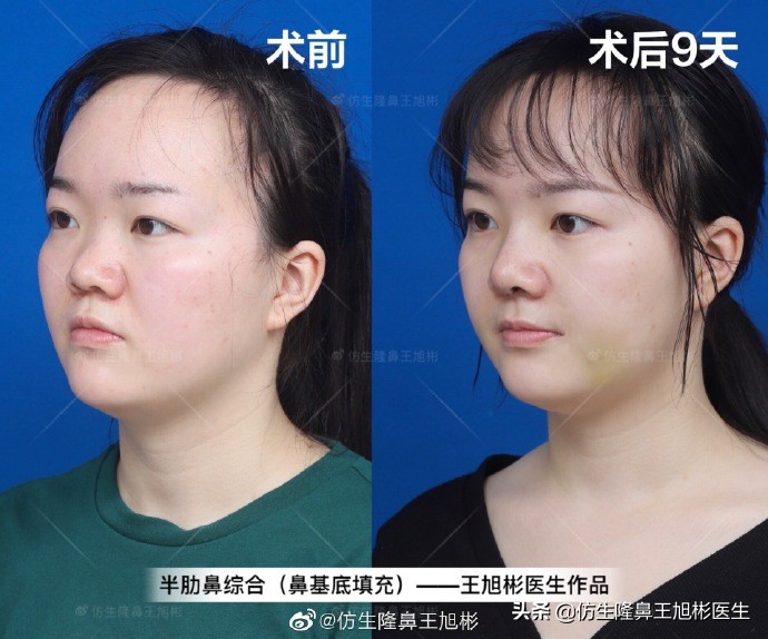 隆鼻太过于自然跟没做一样,隆鼻太自然和没做一样