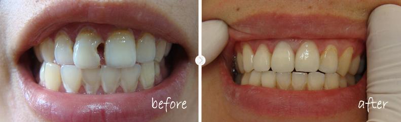 牙缝没清理干净会把牙缝变大吗,牙缝卡了东西导致牙缝变大怎么办