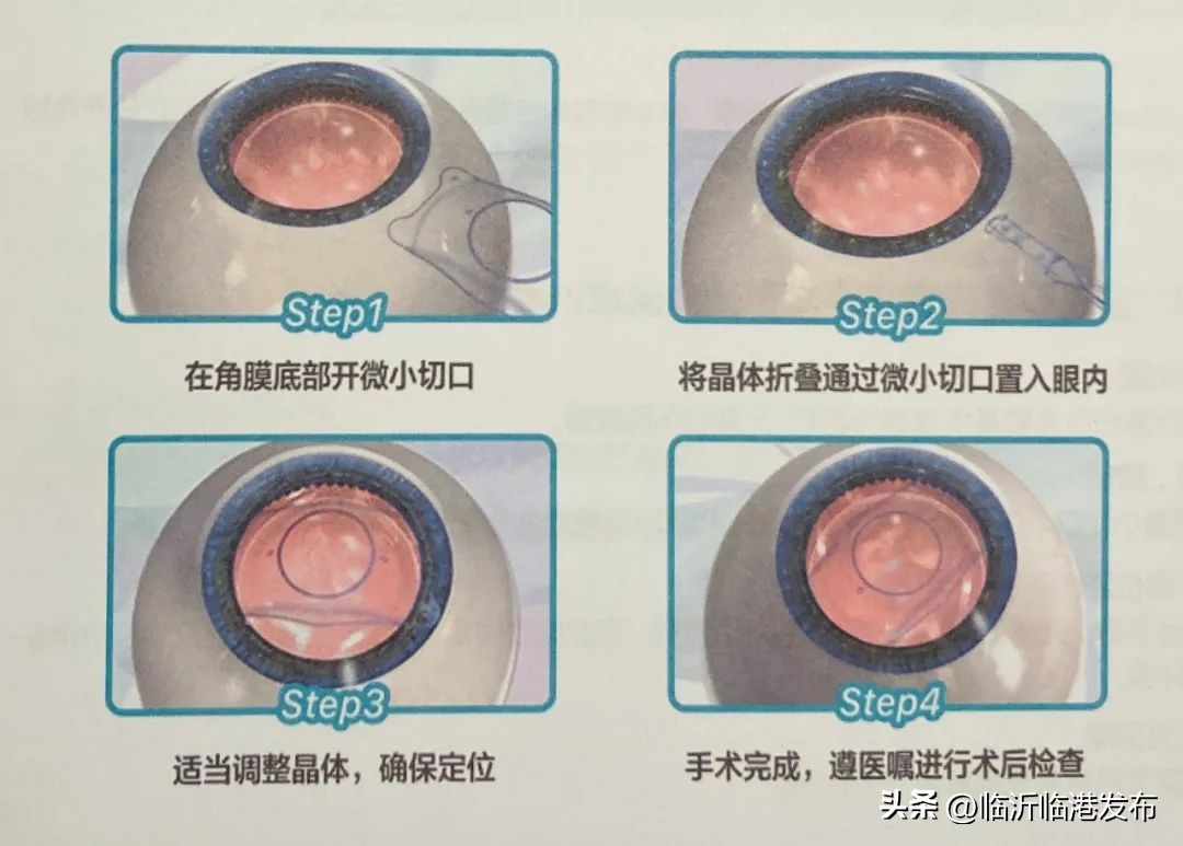 激光手术后视力反弹,激光近视手术做后视力有多少