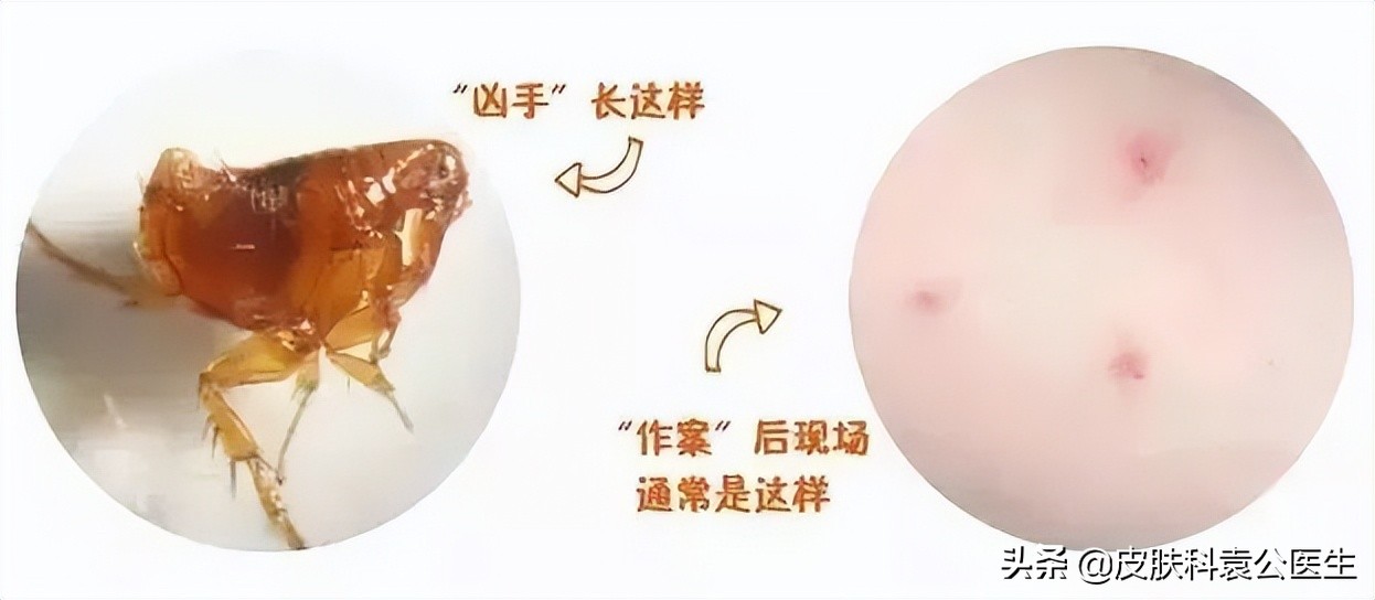 蚊虫叮咬引起的皮炎一年了没好,夏季有哪些虫叮咬会红肿