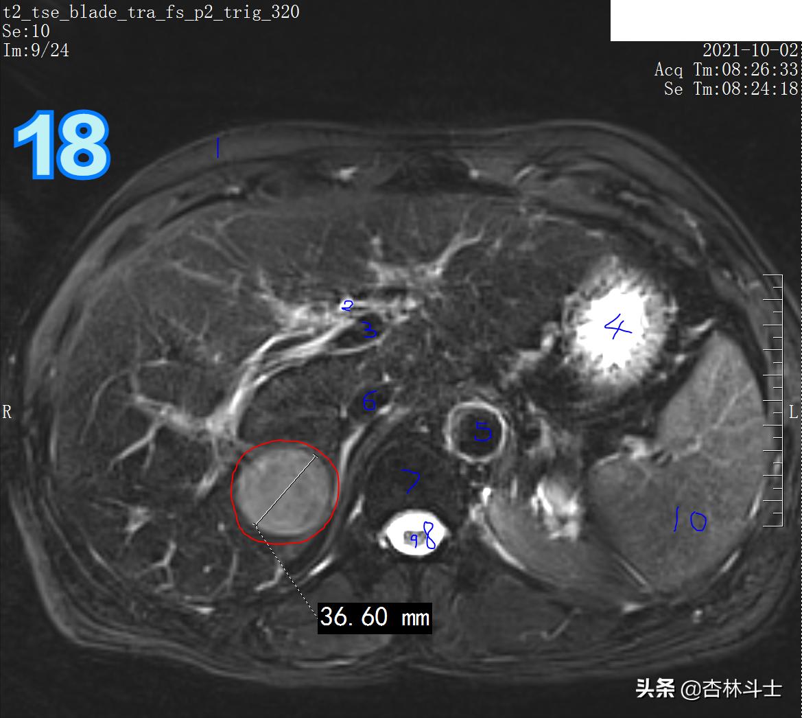 肝癌8公分肿瘤能活多久,肝癌细胞最大长多大