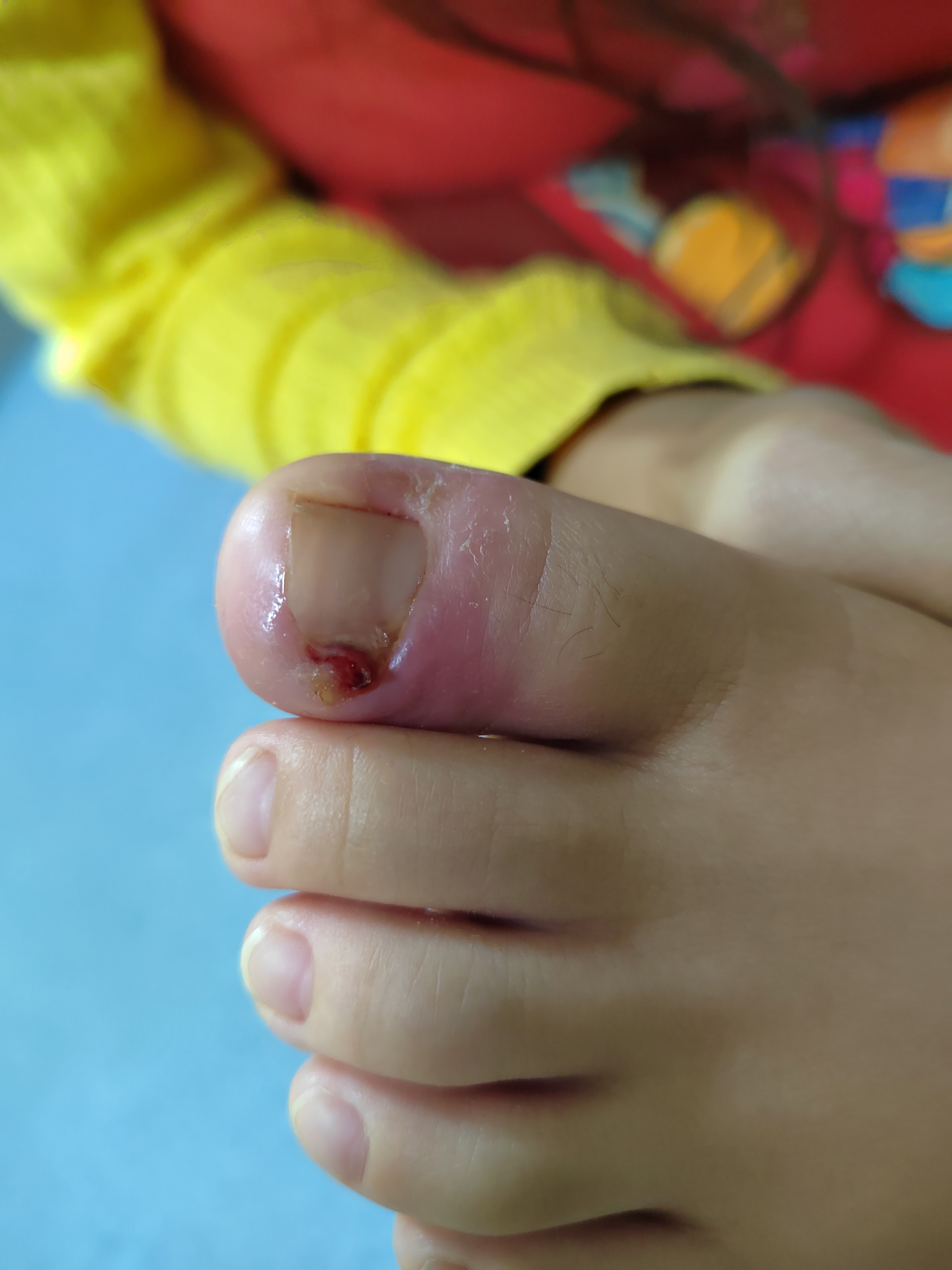 宝宝手指头红肿哭闹,宝宝手指肿胀疼痛是怎么回事