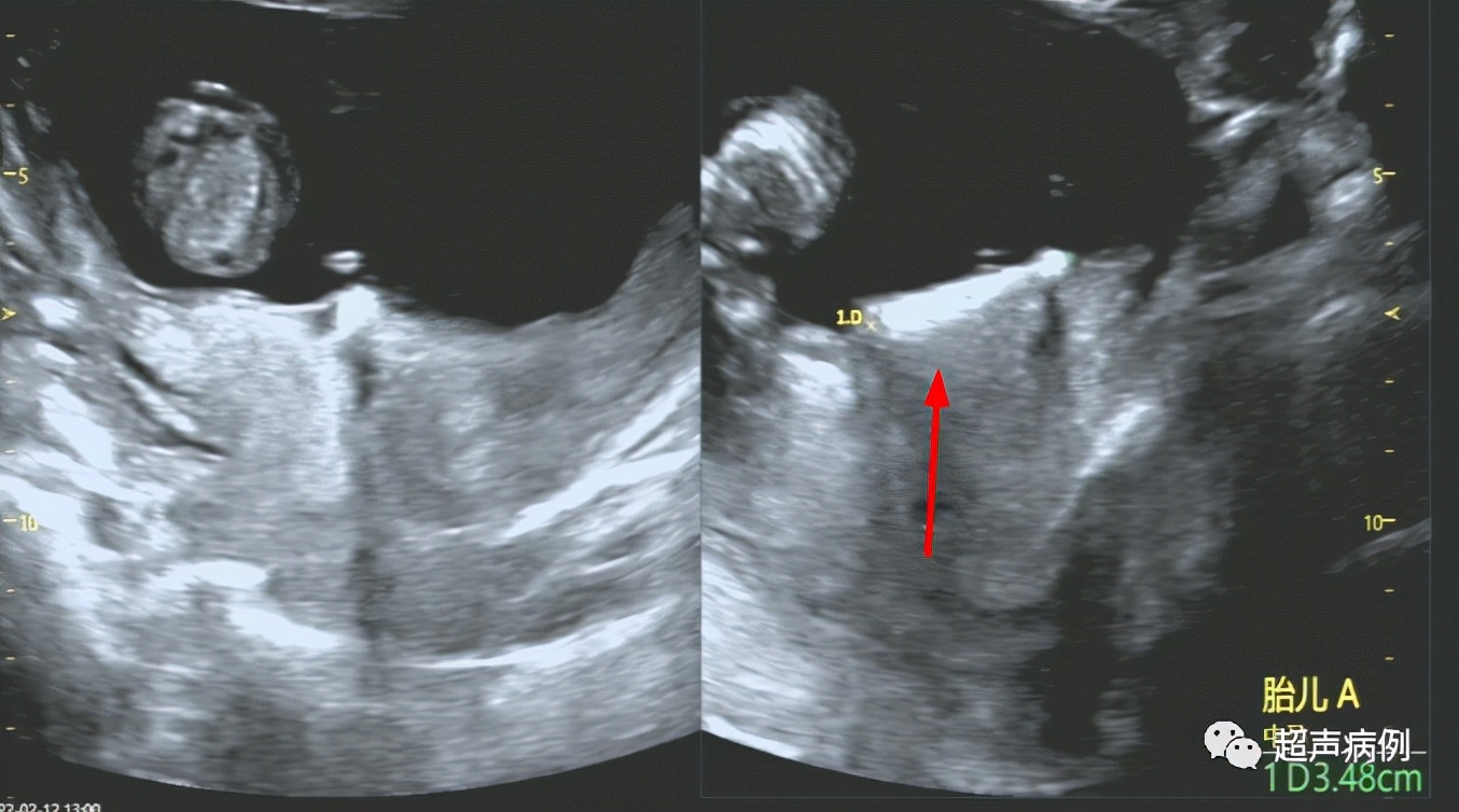 带器妊娠是什么意思,戴节育器妊娠会有什么症状