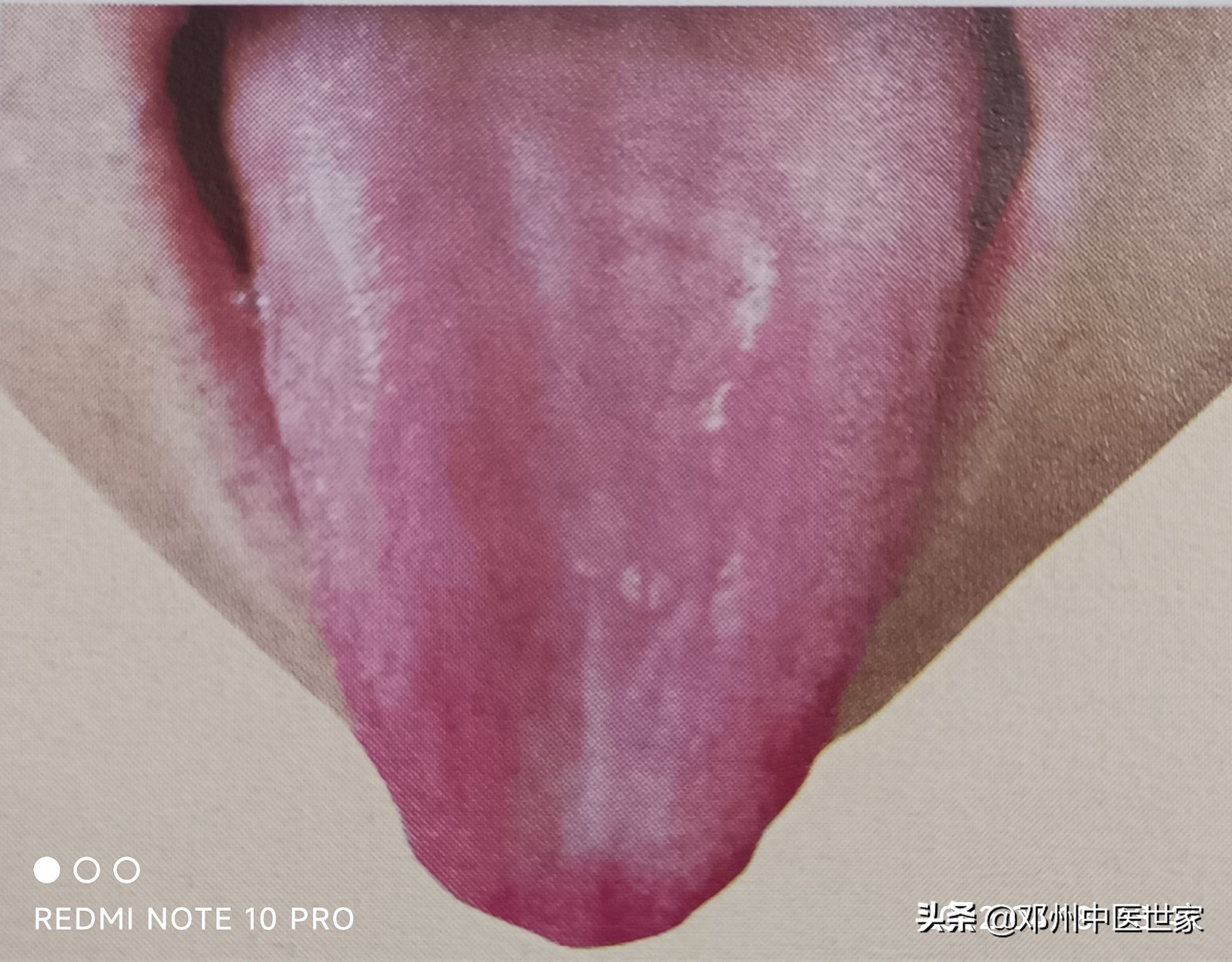 痴呆脑供血不足,痴呆四肢无力