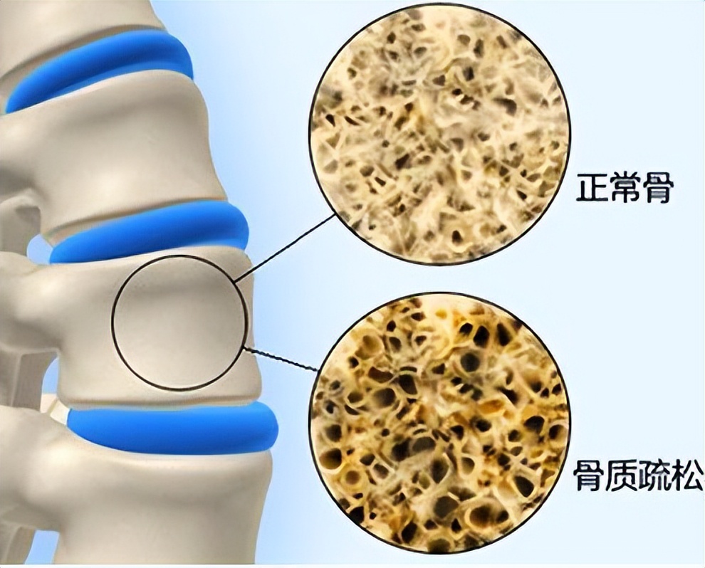 身体钙质流失快是什么原因,成人钙流失怎么补最快最好