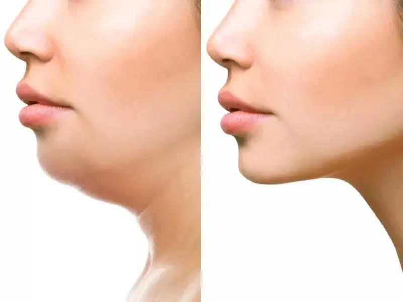双下巴怎么改善最有效,双下巴怎么解决