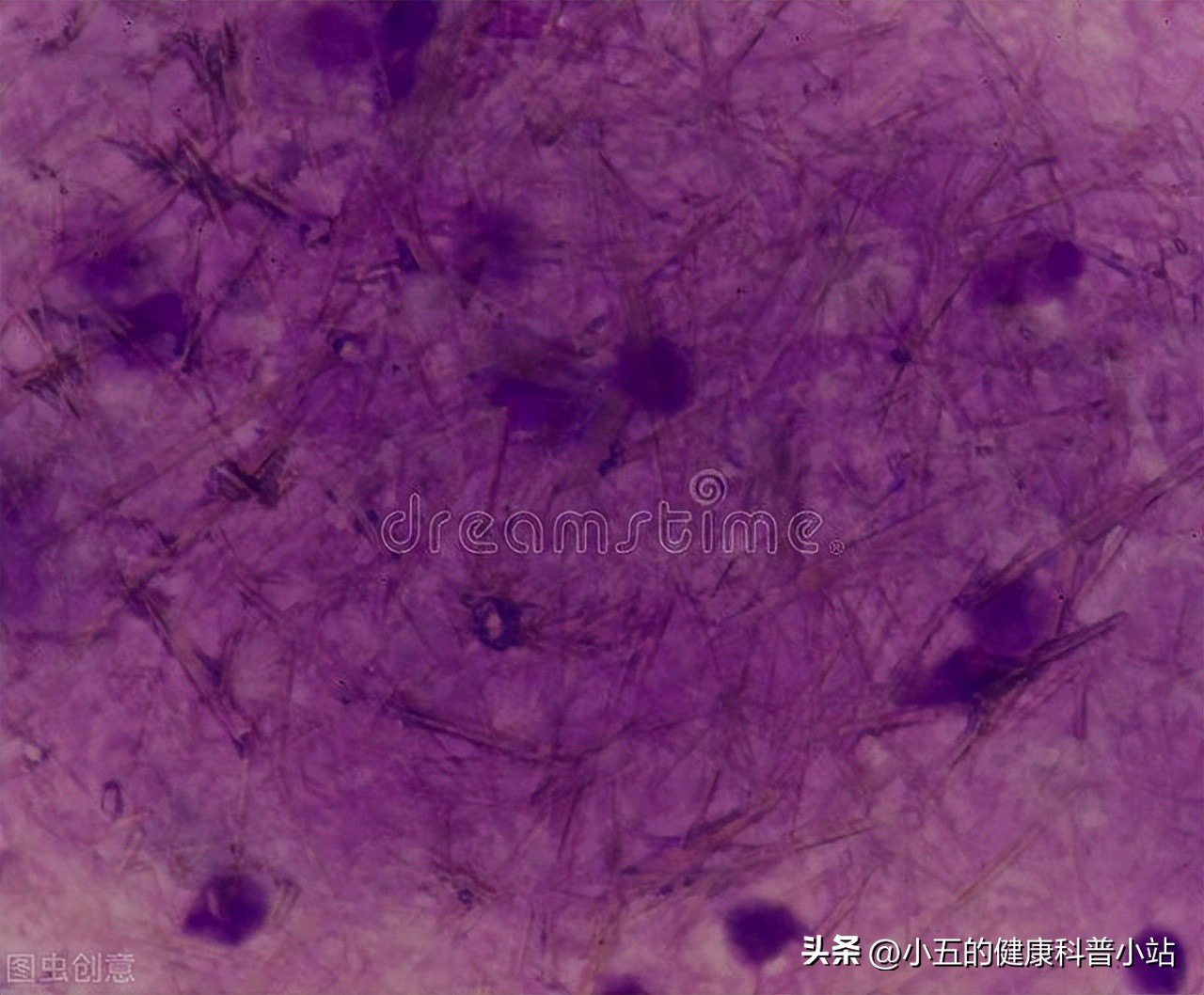 吃苯溴马隆降尿酸痛风发作怎么办,苯溴马隆治疗尿酸高效果怎么样