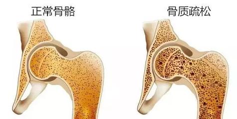 普罗力治疗骨质疏松,雌激素治疗骨质疏松