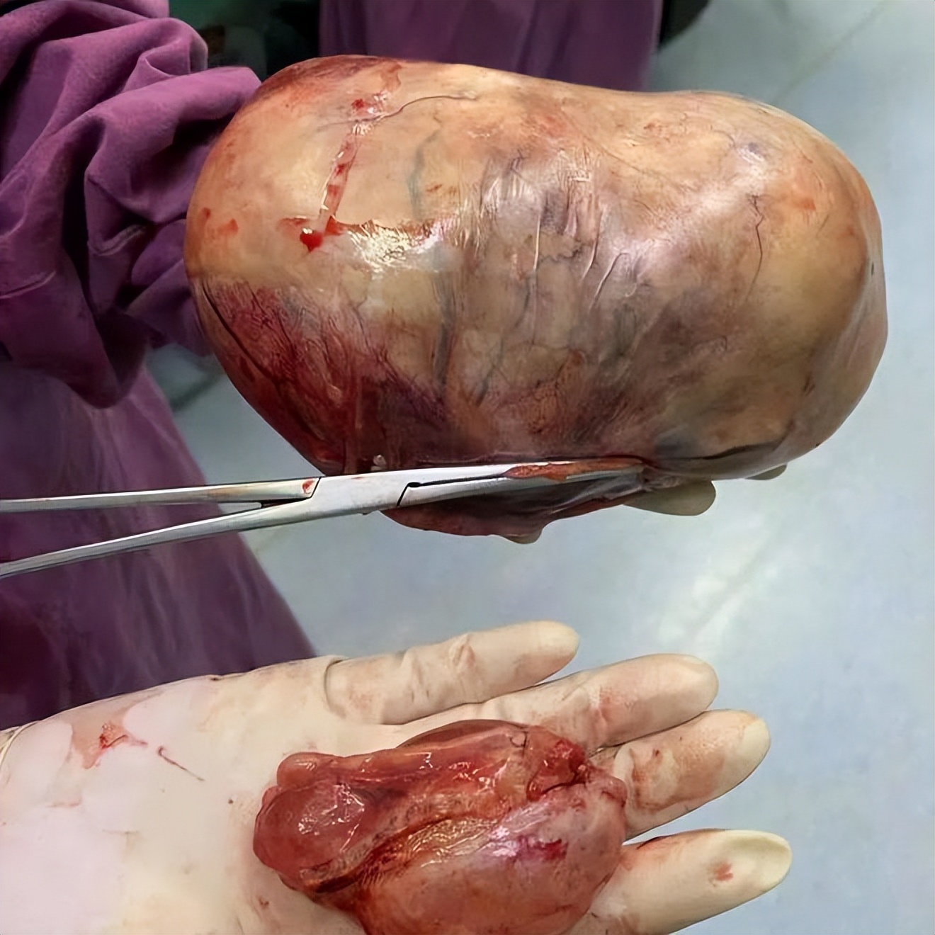 大同市第一人民医院为89岁高龄老人成功实施卵巢肿瘤手术