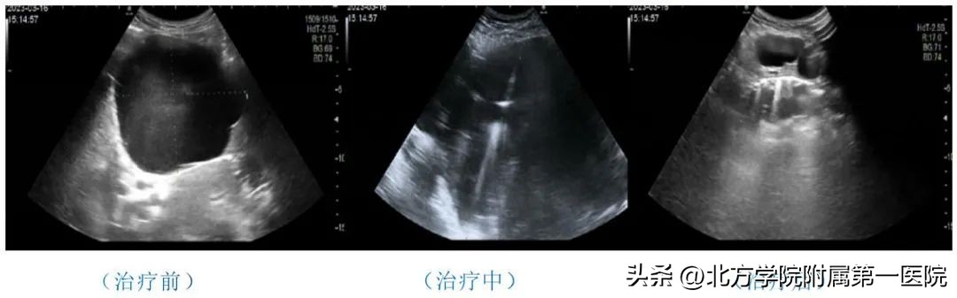 肝脏囊肿超声介入治疗,何谓超声引导经皮穿刺肝囊肿