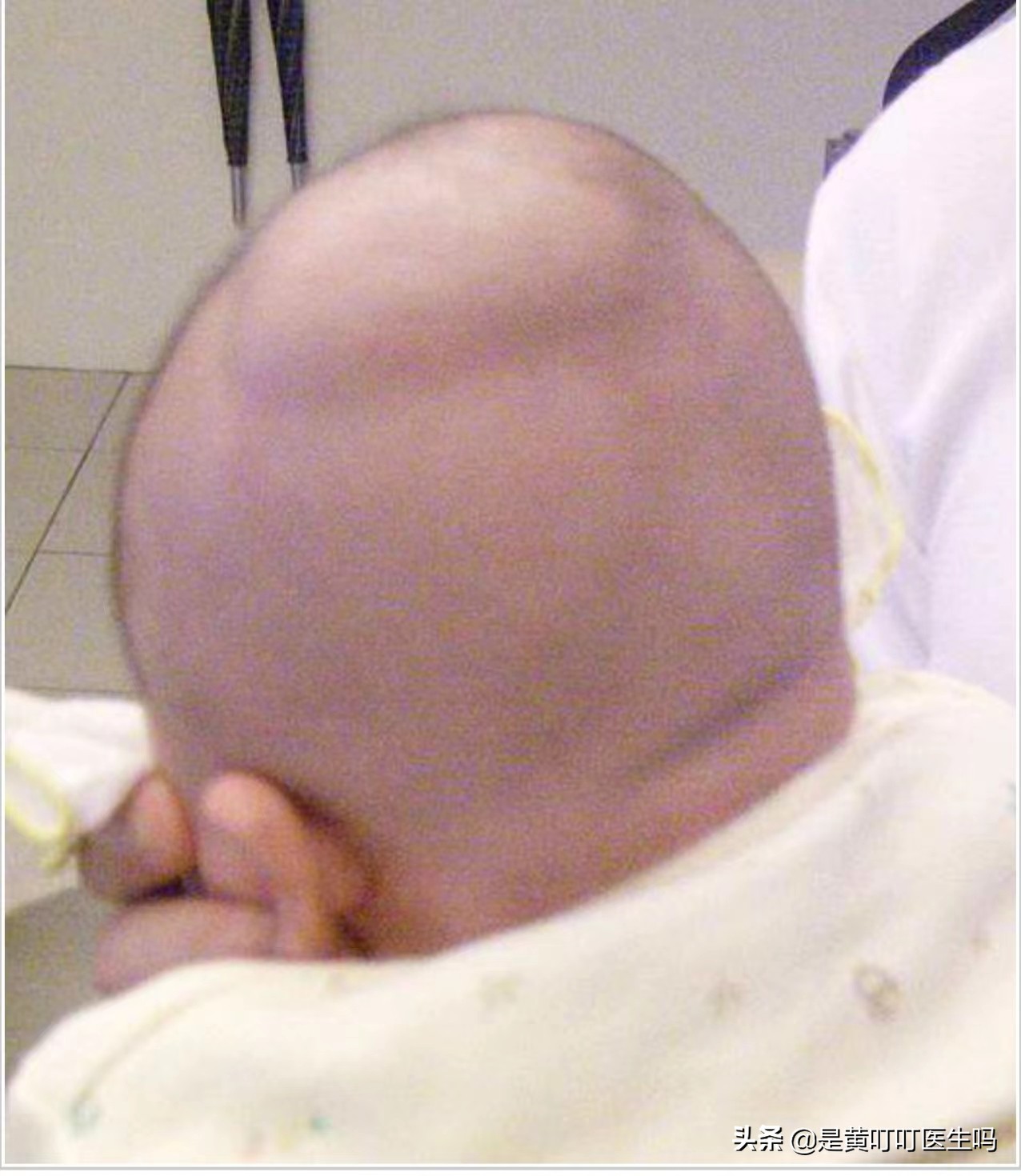 婴儿头部畸形一边大一边小,宝宝刚出生时头顶肿了一个大包