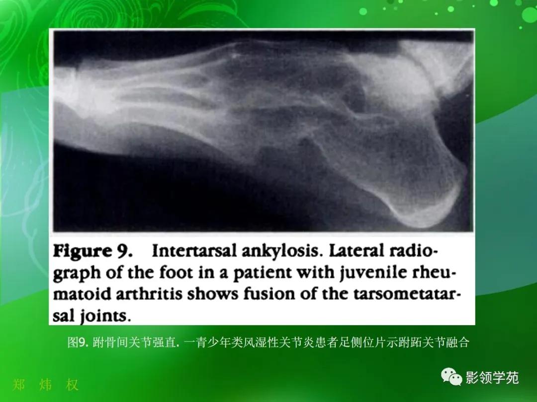 正常跟骨影像图,跟骨正常与变异影像表现图片