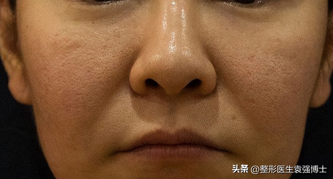 法令纹用药膏能去除吗,法令纹可以消除吗医美