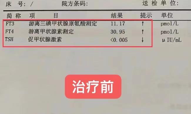 做了碘131出现甲减的几率有多大,碘131后甲减那么可怕吗