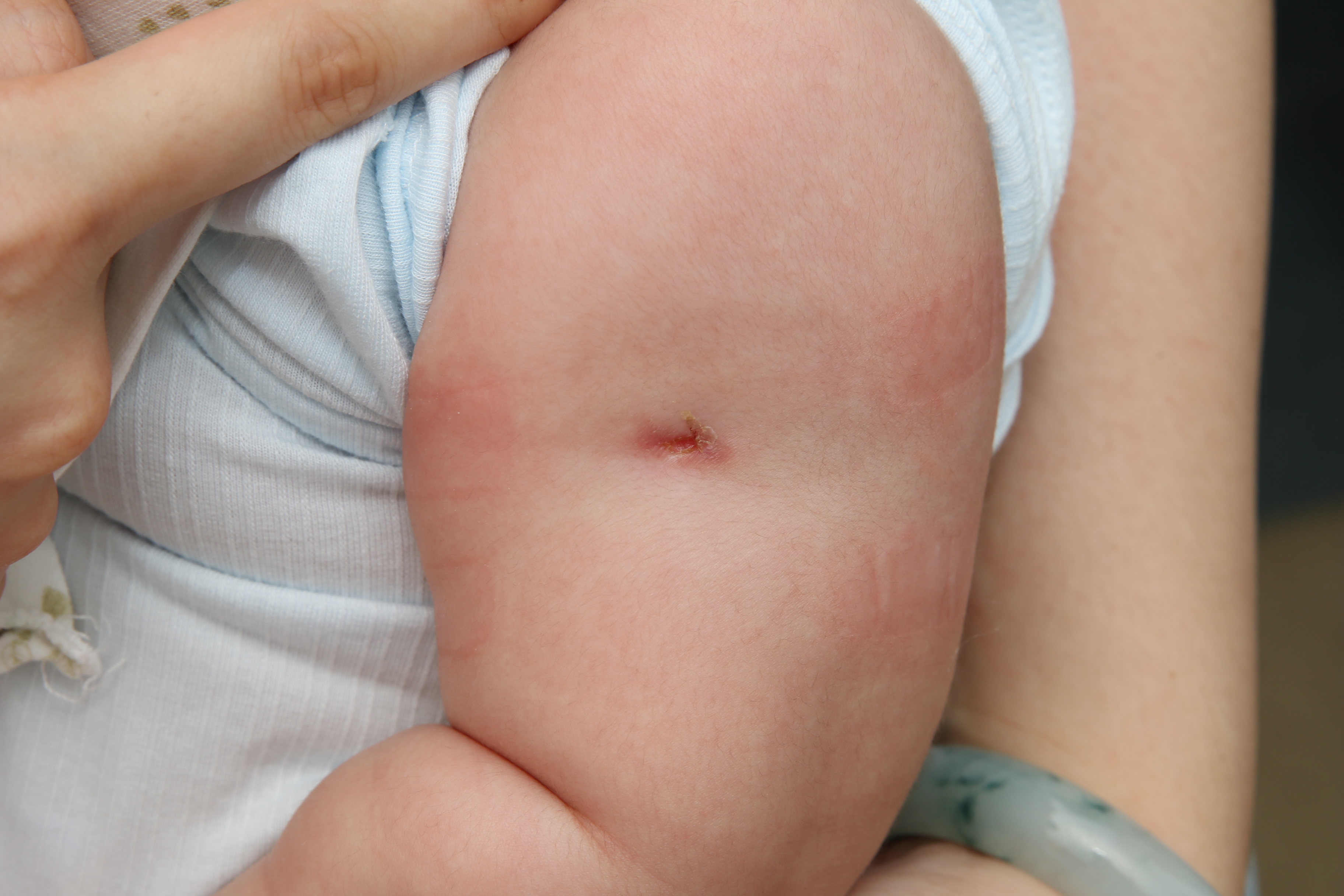 卡介苗接种后为啥有不良反应?