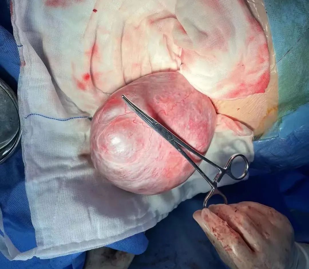 孕期左侧卵巢囊肿能顺产吗,孕妇卵巢囊肿20厘米