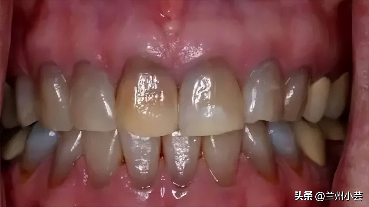 牙齿发黄可以用含氟牙膏吗,牙龈肿痛发黄用什么牙膏