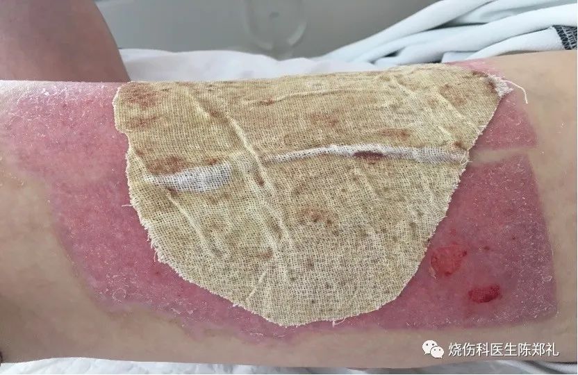 慢性创面患者的敷料运用及选择,创面换药敷料的选择
